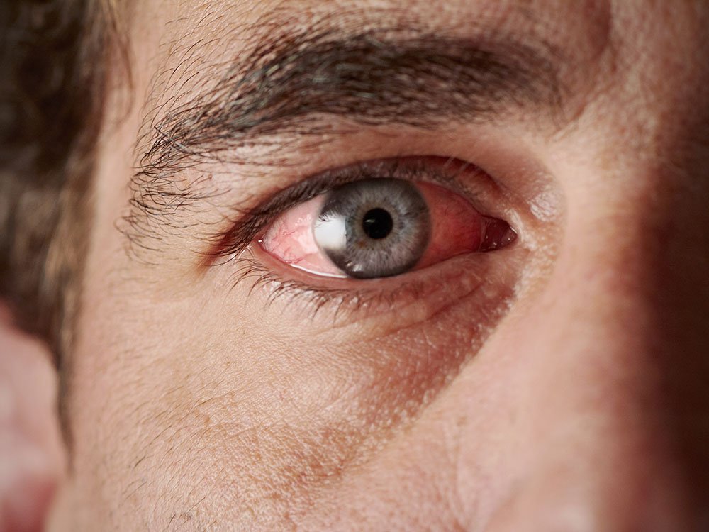 Closeup of man experiencing dry irritated eyes