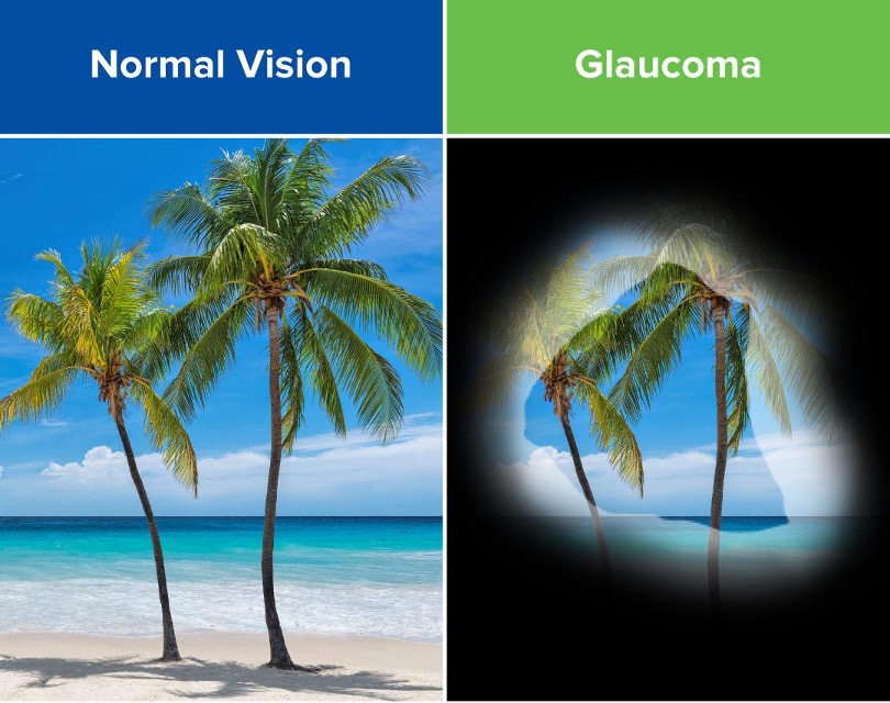 Comparison photo of a palm tree with normal vision versus glaucoma
