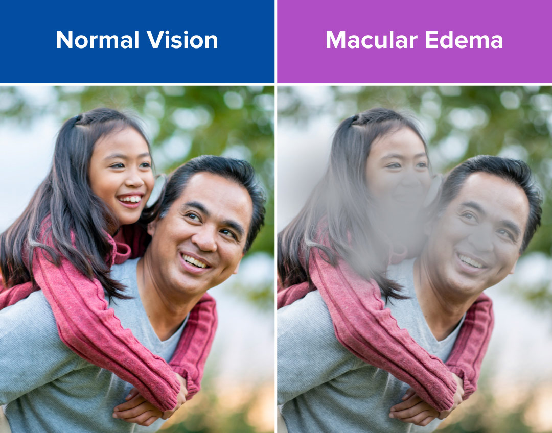 Vision with edema