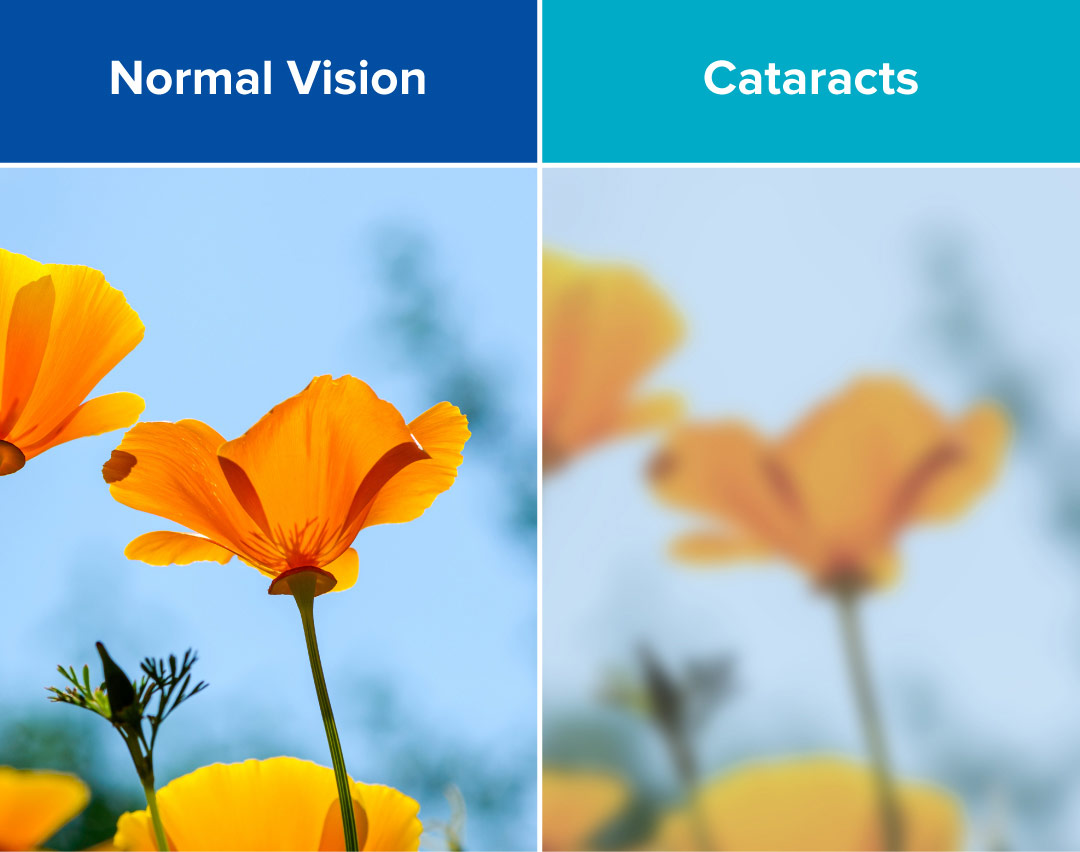 A comparison of normal vision vs cataracts