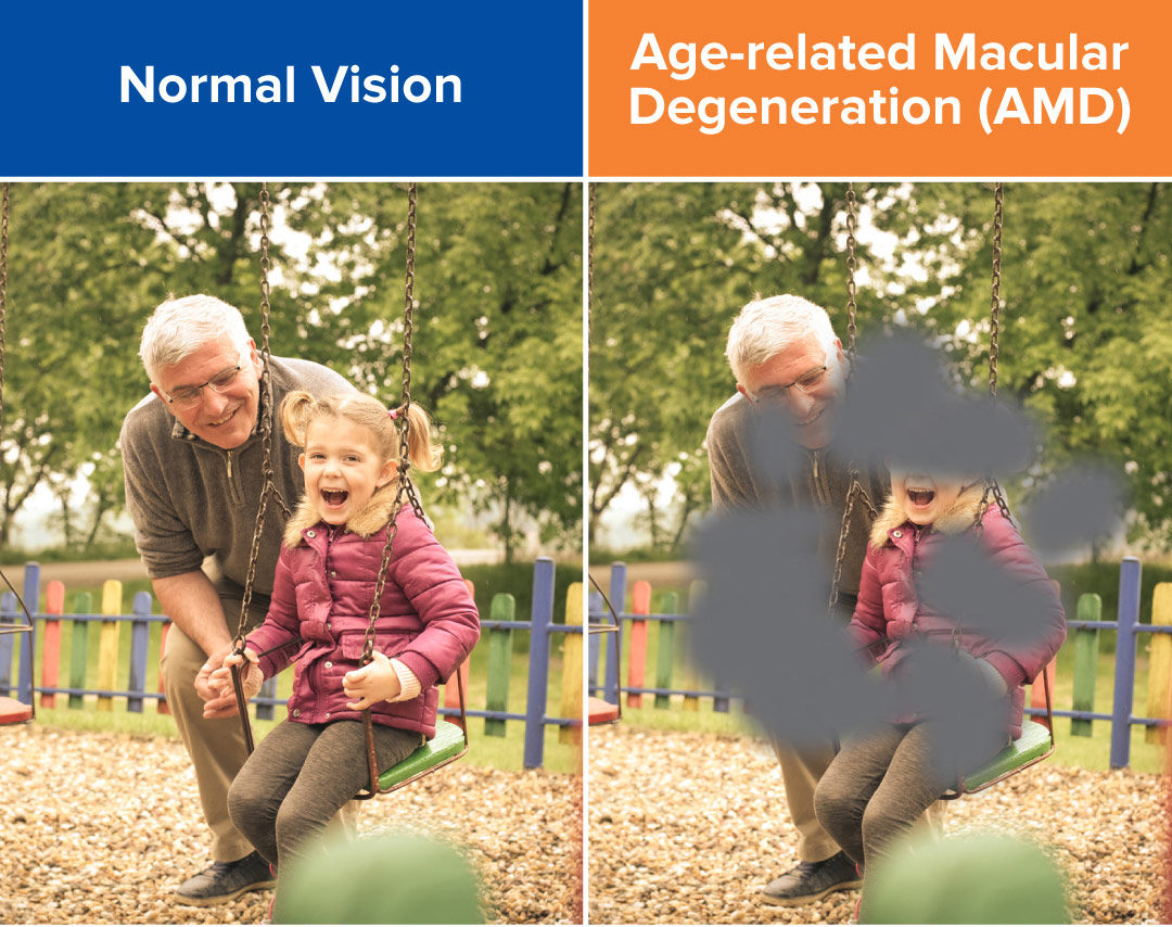 Picture depicting dark spots in vision to denote Age-Related Macular Degeneration