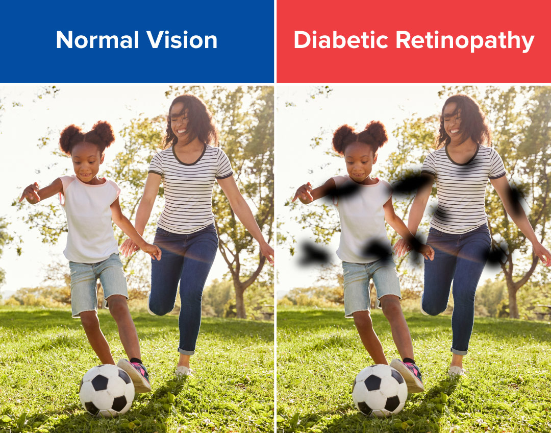 A comparison of normal vision vs diabetic retinopathy